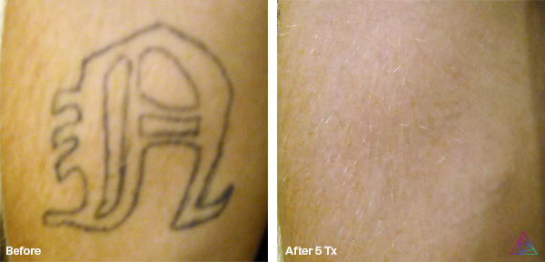 Before and after tattoo removal